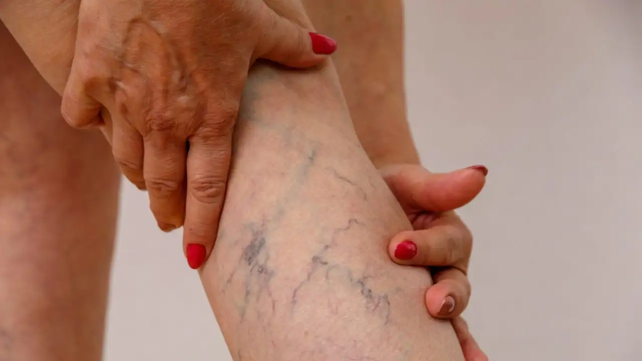Varicose Veins